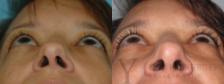 Blepharoplasty Before & After Photo | San Luis Obispo, CA | The Aesthetic Center