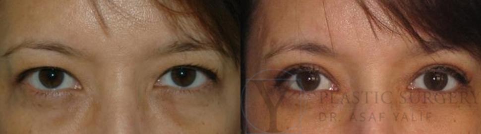 Blepharoplasty Before & After Photo | San Luis Obispo, CA | The Aesthetic Center