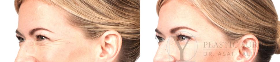 BOTOX® Cosmetic Before & After Photo | San Luis Obispo, CA | The Aesthetic Center