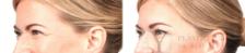 BOTOX® Cosmetic Before & After Photo | San Luis Obispo, CA | The Aesthetic Center