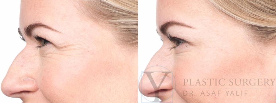 BOTOX® Cosmetic Before & After Photo | San Luis Obispo, CA | The Aesthetic Center