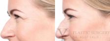 BOTOX® Cosmetic Before & After Photo | San Luis Obispo, CA | The Aesthetic Center