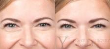 BOTOX® Cosmetic Before & After Photo | San Luis Obispo, CA | The Aesthetic Center