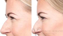 BOTOX® Cosmetic Before & After Photo | San Luis Obispo, CA | The Aesthetic Center