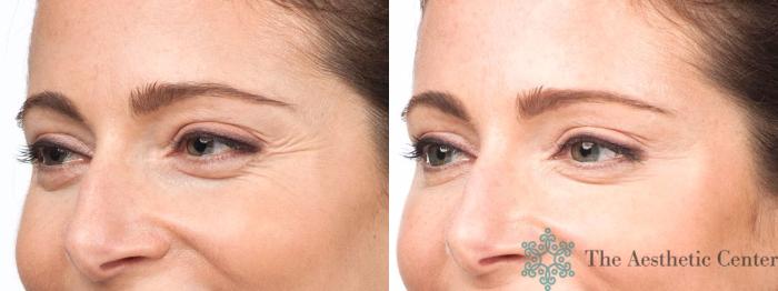 BOTOX® Cosmetic Before & After Photo | San Luis Obispo, CA | The Aesthetic Center