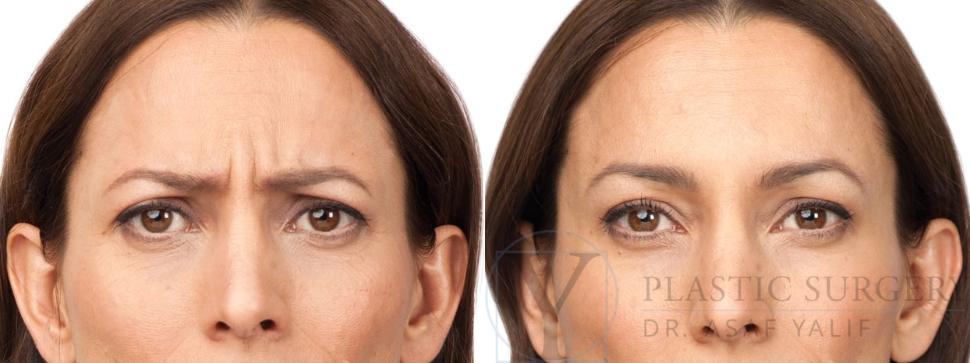 BOTOX® Cosmetic Before & After Photo | San Luis Obispo, CA | The Aesthetic Center