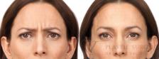 BOTOX® Cosmetic Before & After Photo | San Luis Obispo, CA | The Aesthetic Center