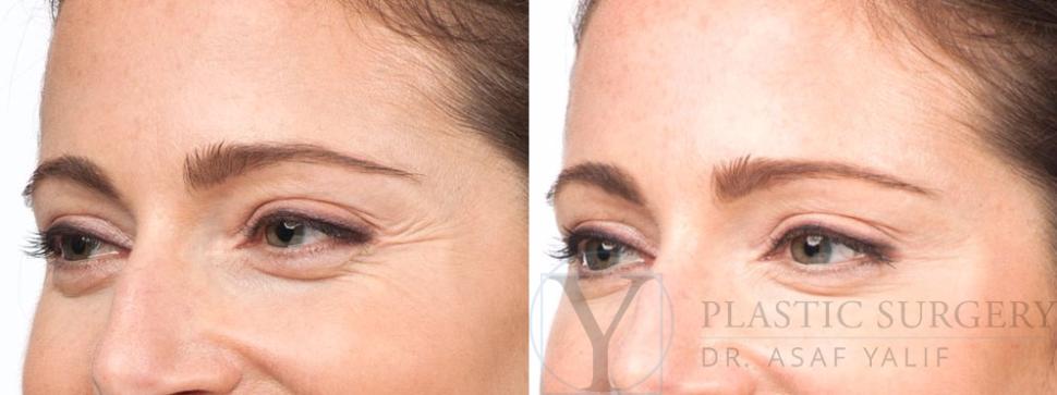 BOTOX® Cosmetic Before & After Photo | San Luis Obispo, CA | The Aesthetic Center