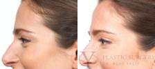 BOTOX® Cosmetic Before & After Photo | San Luis Obispo, CA | The Aesthetic Center