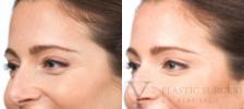 BOTOX® Cosmetic Before & After Photo | San Luis Obispo, CA | The Aesthetic Center