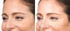 BOTOX® Cosmetic Before & After Photo | San Luis Obispo, CA | The Aesthetic Center