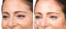 BOTOX® Cosmetic Before & After Photo | San Luis Obispo, CA | The Aesthetic Center