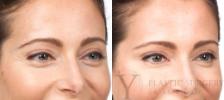 BOTOX® Cosmetic Before & After Photo | San Luis Obispo, CA | The Aesthetic Center