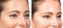 BOTOX® Cosmetic Before & After Photo | San Luis Obispo, CA | The Aesthetic Center