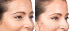 BOTOX® Cosmetic Before & After Photo | San Luis Obispo, CA | The Aesthetic Center