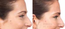 BOTOX® Cosmetic Before & After Photo | San Luis Obispo, CA | The Aesthetic Center