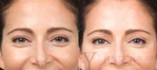 BOTOX® Cosmetic Before & After Photo | San Luis Obispo, CA | The Aesthetic Center