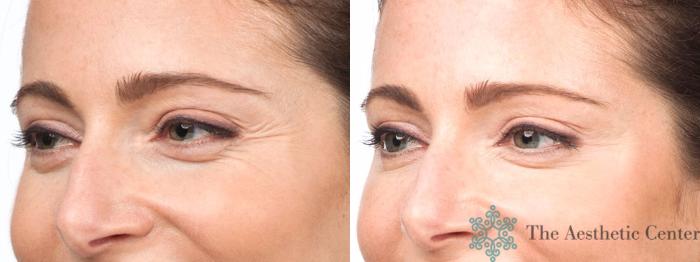 BOTOX® Cosmetic Before & After Photo | San Luis Obispo, CA | The Aesthetic Center