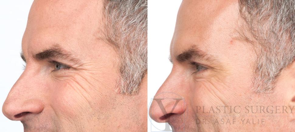 BOTOX® Cosmetic Before & After Photo | San Luis Obispo, CA | The Aesthetic Center