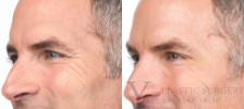 BOTOX® Cosmetic Before & After Photo | San Luis Obispo, CA | The Aesthetic Center