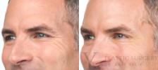 BOTOX® Cosmetic Before & After Photo | San Luis Obispo, CA | The Aesthetic Center