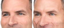 BOTOX® Cosmetic Before & After Photo | San Luis Obispo, CA | The Aesthetic Center