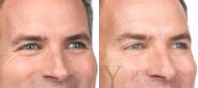 BOTOX® Cosmetic Before & After Photo | San Luis Obispo, CA | The Aesthetic Center