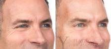 BOTOX® Cosmetic Before & After Photo | San Luis Obispo, CA | The Aesthetic Center