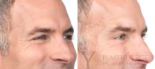 BOTOX® Cosmetic Before & After Photo | San Luis Obispo, CA | The Aesthetic Center