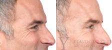 BOTOX® Cosmetic Before & After Photo | San Luis Obispo, CA | The Aesthetic Center