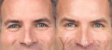 BOTOX® Cosmetic Before & After Photo | San Luis Obispo, CA | The Aesthetic Center