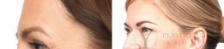 BOTOX® Cosmetic Before & After Photo | San Luis Obispo, CA | The Aesthetic Center