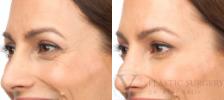 BOTOX® Cosmetic Before & After Photo | San Luis Obispo, CA | The Aesthetic Center