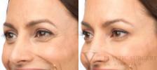 BOTOX® Cosmetic Before & After Photo | San Luis Obispo, CA | The Aesthetic Center