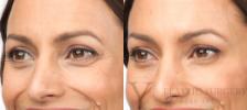 BOTOX® Cosmetic Before & After Photo | San Luis Obispo, CA | The Aesthetic Center