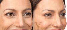 BOTOX® Cosmetic Before & After Photo | San Luis Obispo, CA | The Aesthetic Center