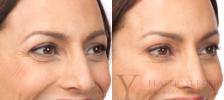 BOTOX® Cosmetic Before & After Photo | San Luis Obispo, CA | The Aesthetic Center