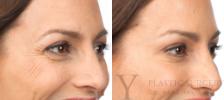 BOTOX® Cosmetic Before & After Photo | San Luis Obispo, CA | The Aesthetic Center