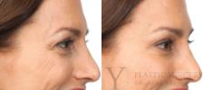 BOTOX® Cosmetic Before & After Photo | San Luis Obispo, CA | The Aesthetic Center