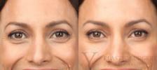 BOTOX® Cosmetic Before & After Photo | San Luis Obispo, CA | The Aesthetic Center