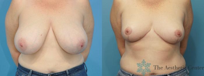 Breast Reduction Before & After Photo | San Luis Obispo, CA | The Aesthetic Center