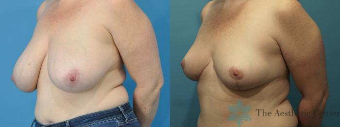 Breast Reduction Before & After Photo | San Luis Obispo, CA | The Aesthetic Center