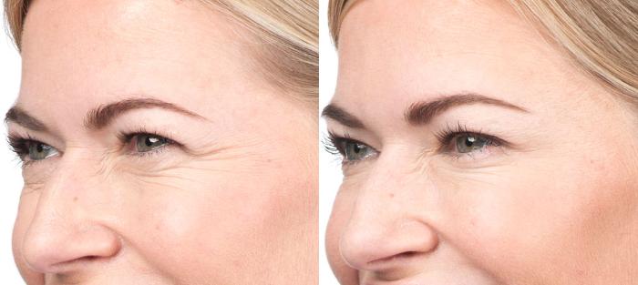 Blepharoplasty Before & After Photo | San Luis Obispo, CA | The Aesthetic Center