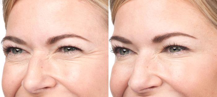 BOTOX® Cosmetic Before & After Photo | San Luis Obispo, CA | The Aesthetic Center