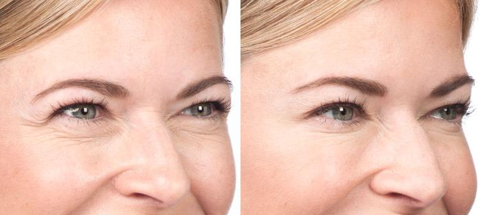 Blepharoplasty Before & After Photo | San Luis Obispo, CA | The Aesthetic Center