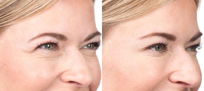 Blepharoplasty Before & After Photo | San Luis Obispo, CA | The Aesthetic Center