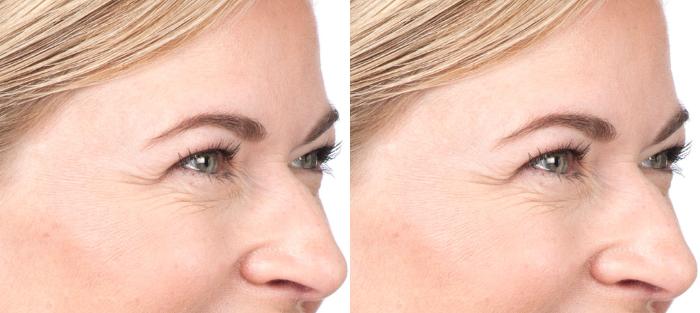 BOTOX® Cosmetic Before & After Photo | San Luis Obispo, CA | The Aesthetic Center