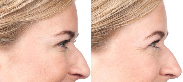 BOTOX® Cosmetic Before & After Photo | San Luis Obispo, CA | The Aesthetic Center