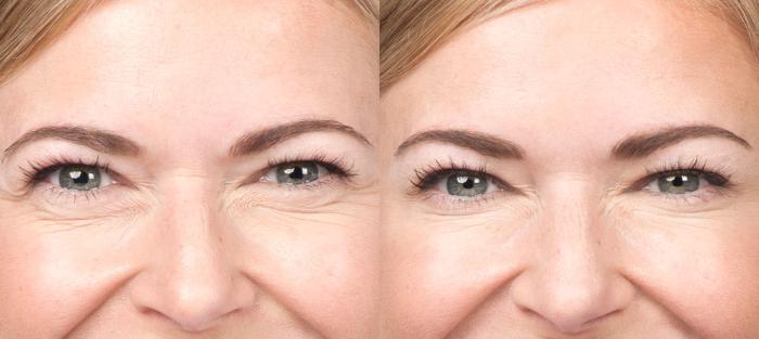 BOTOX® Cosmetic Before & After Photo | San Luis Obispo, CA | The Aesthetic Center