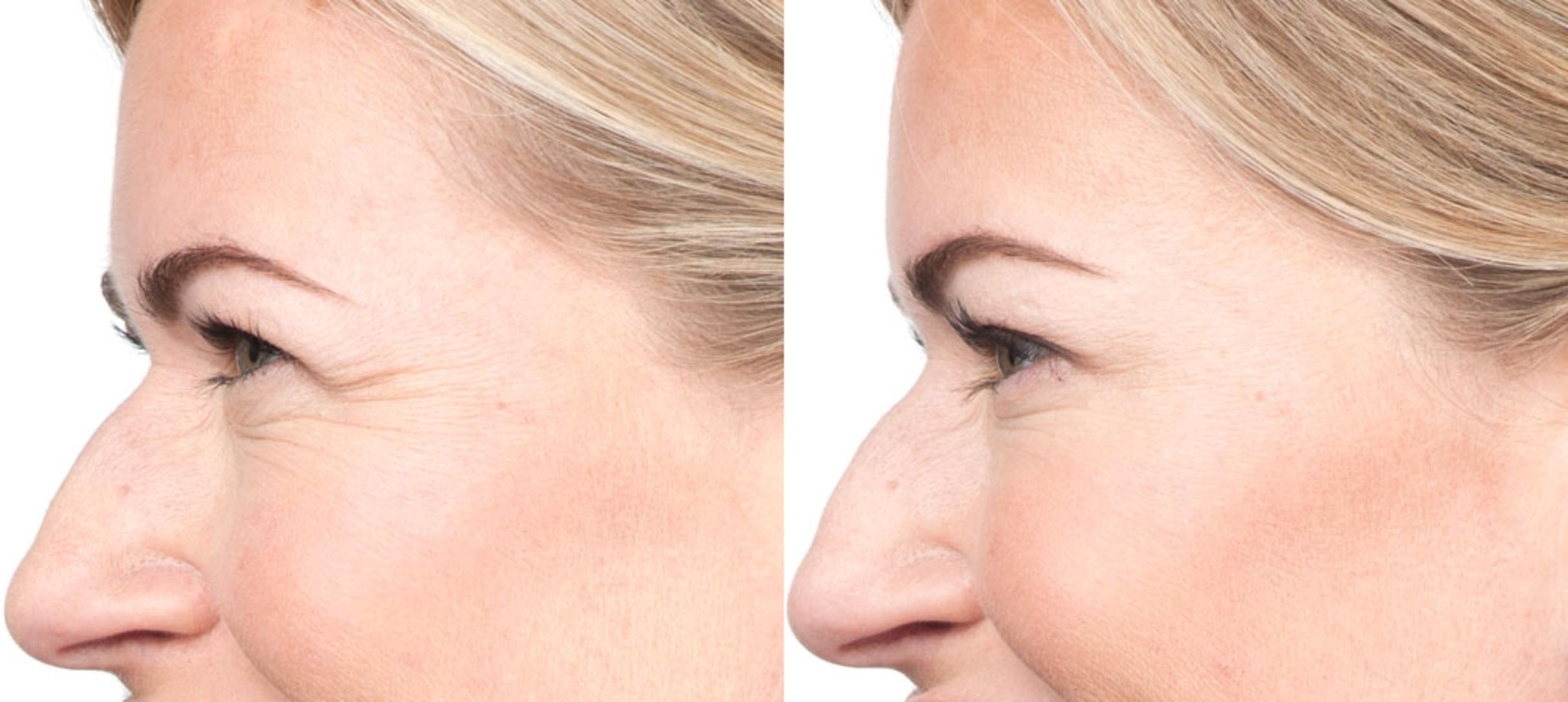 Blepharoplasty Before & After Photo | San Luis Obispo, CA | The Aesthetic Center